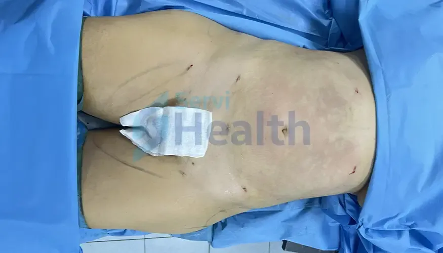 Résultat après liposuccion en Tunisie