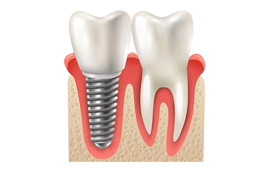 Implant dentaire en Tunisie pour remplacer une ou plusieurs dents manquantes